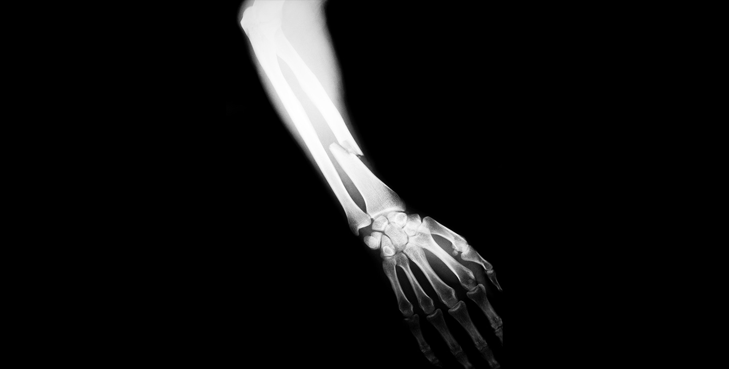 AMG_IMG_X-ray image of human arm with fracture